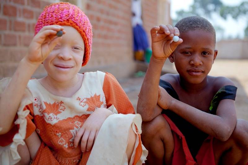 El drama de los albinos en Tanzania