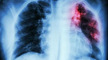 La tuberculosis sesgó la vida de 1,3 millones de personas en 2022